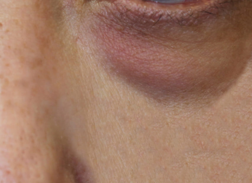 下まぶた たるみ取り (裏ハムラ法) Before