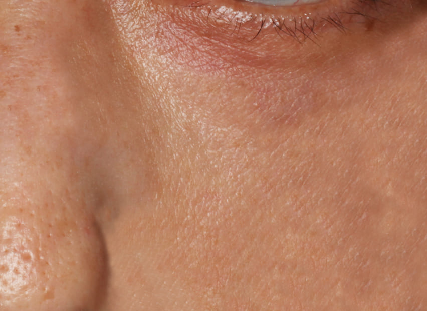 下まぶた たるみ取り (裏ハムラ法) After