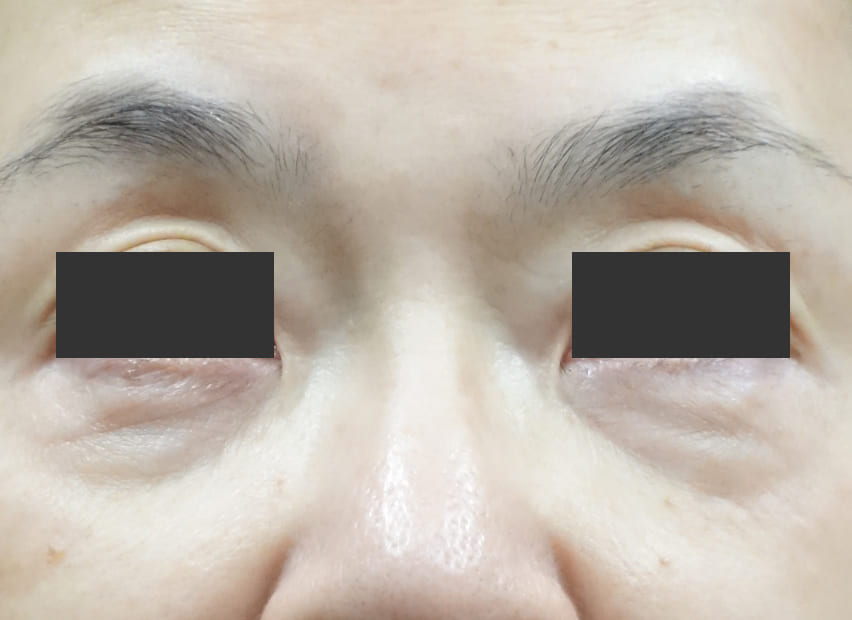 目の下のたるみ取り（バーチュRF） Before