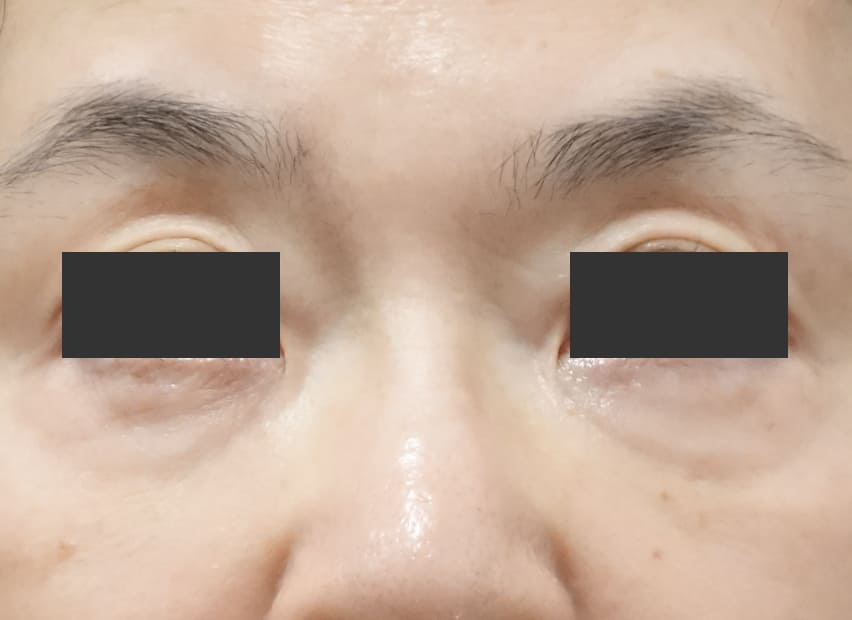 目の下のたるみ取り（バーチュRF） After