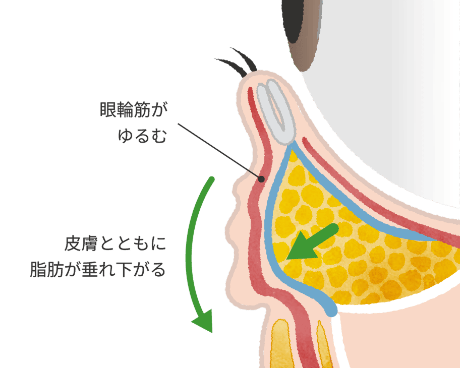 眼輪筋の筋力の衰えによる目元のたるみ