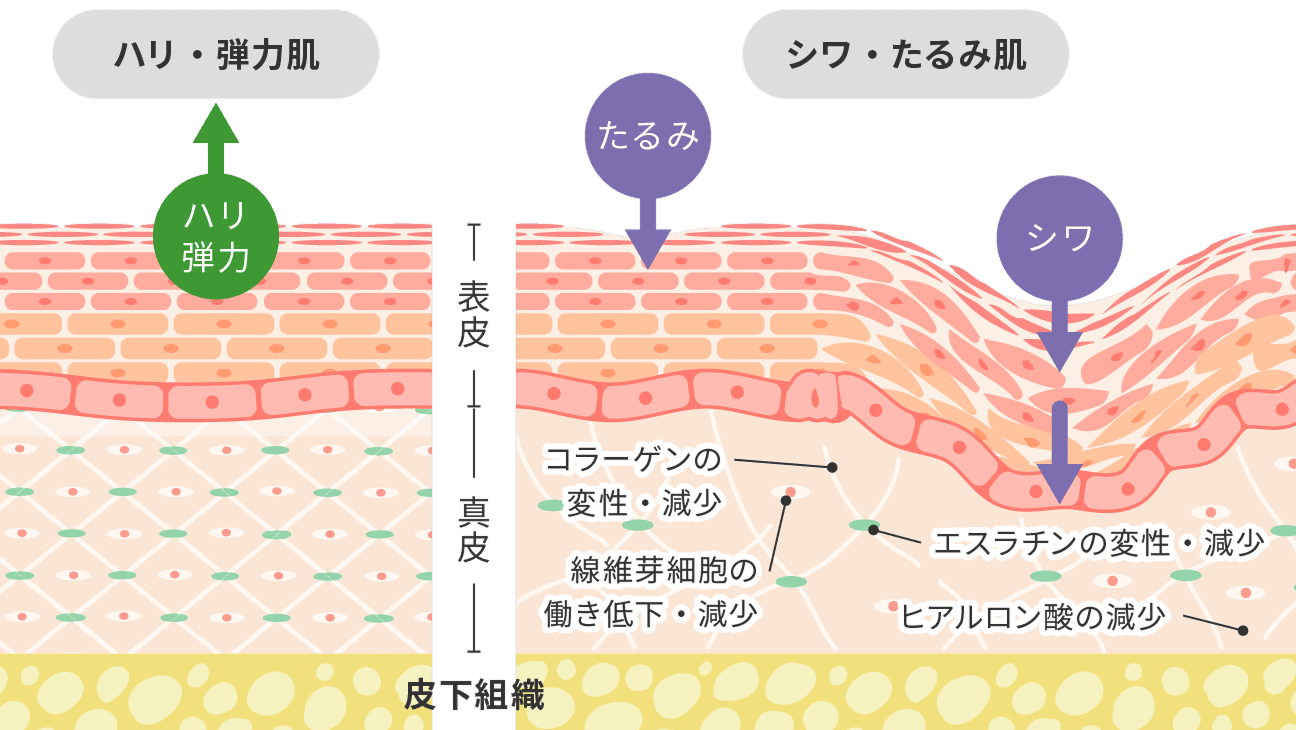ハリや弾力の低下による目の下のクマ・たるみ