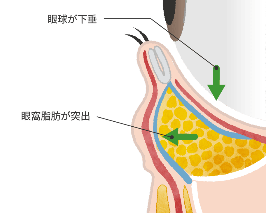 加齢による眼球が下がり眼窩脂肪が出る