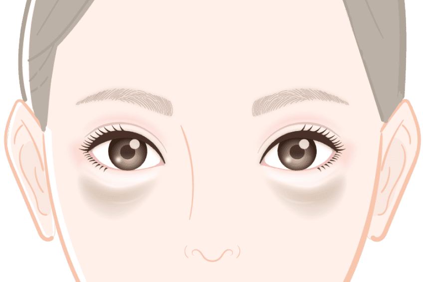 目の下のたるみとクマ