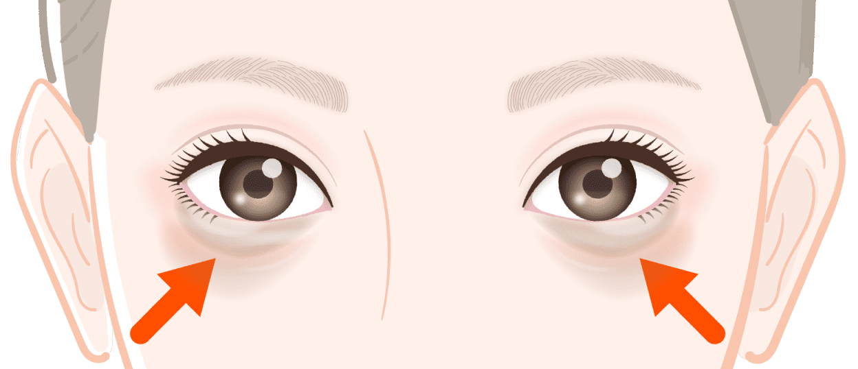 ＜過剰脱脂＞トラブル！目の下のたるみ（脱脂）の「取りすぎ」