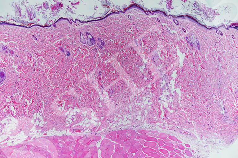 RF（高周波）によるタイトニング効果