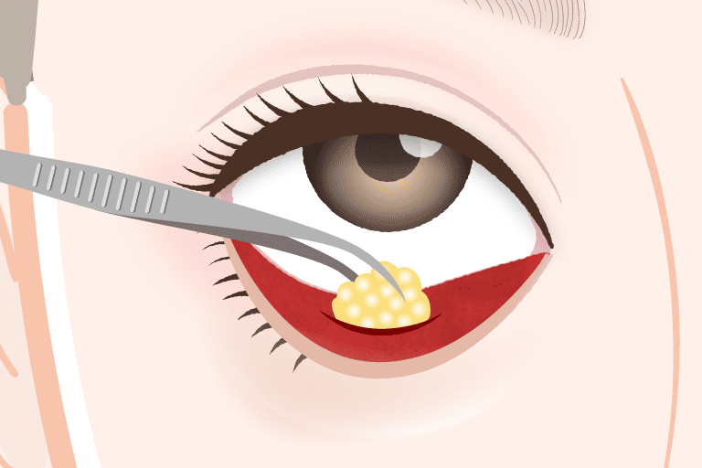 下まぶたの脂肪除去